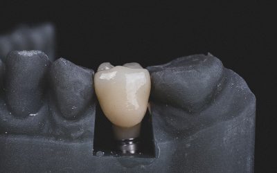 Dental Implants | replacing your missing teeth