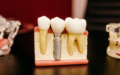 Bone Grafts/Sinus Lifts