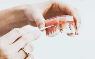 About Implants
