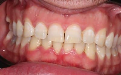Vaping On Your Teeth and Mouth