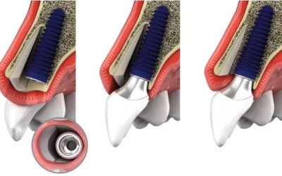 The Socket Shield Technique