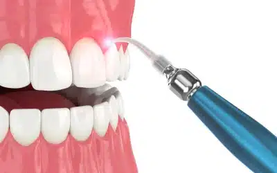 Lasers vs. Periodontitis Treatments