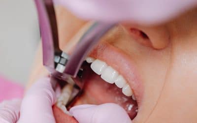Signs You Need a Root Canal: 3 Warning Signs You Shouldn’t Ignore