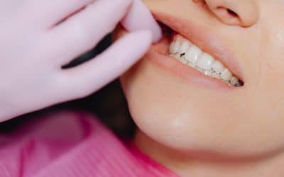 Professional Teeth Whitening: How to Achieve a Brighter, More Confident Smile